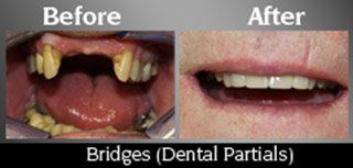 Dental Partials
