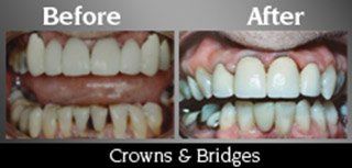Crowns And Bridges