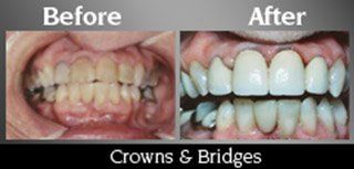 Crowns And Bridges
