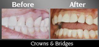 Crowns And Bridges