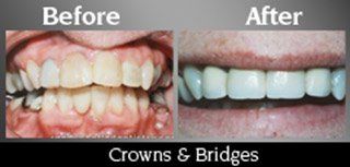 Crowns And Bridges