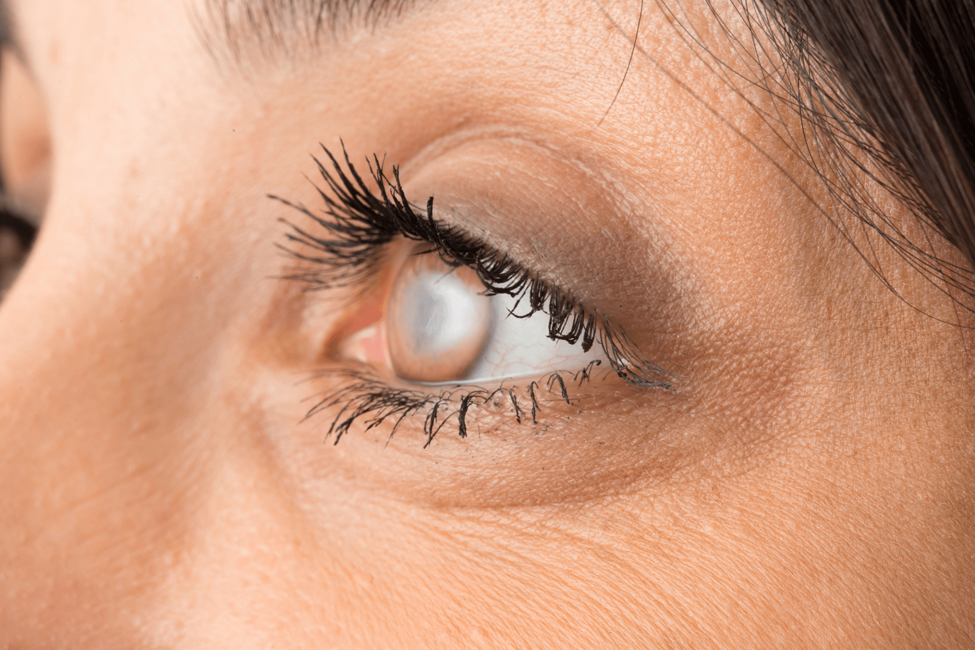 Glaucoma