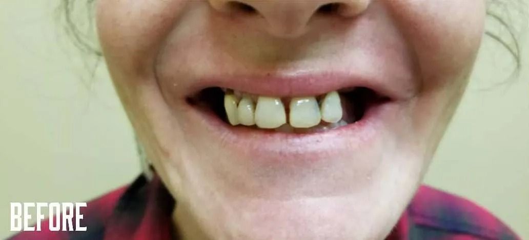 Close-up of a person's teeth before dental work. The teeth are discolored and uneven. Text 