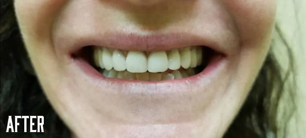 Close-up of a person's smiling mouth showing white teeth.