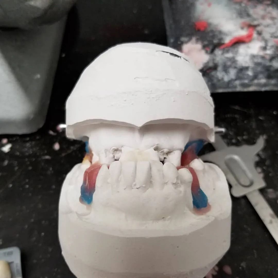 Dental model with wax bite registration. White plaster casts with red and blue wax.