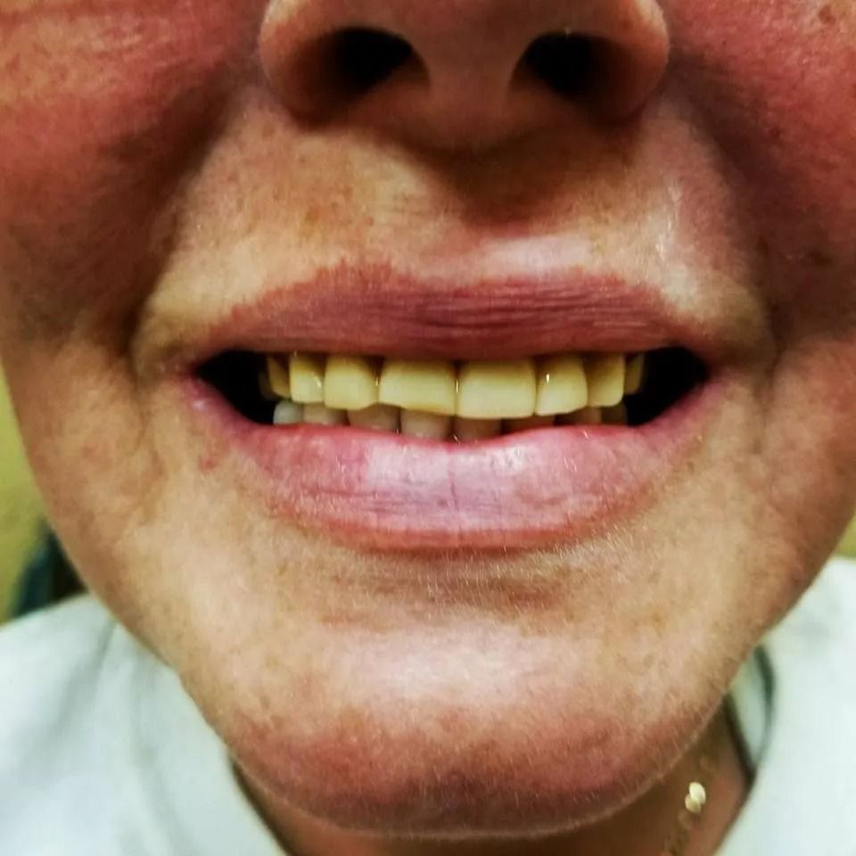 Close-up of a person's mouth with visible teeth and lips; person is smiling, showing the teeth.