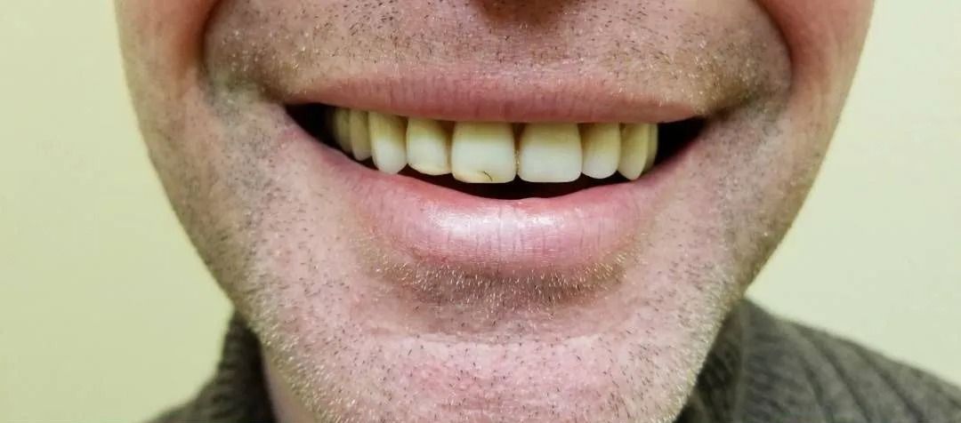 Close-up of a smiling mouth showing a row of teeth; lips are pink.