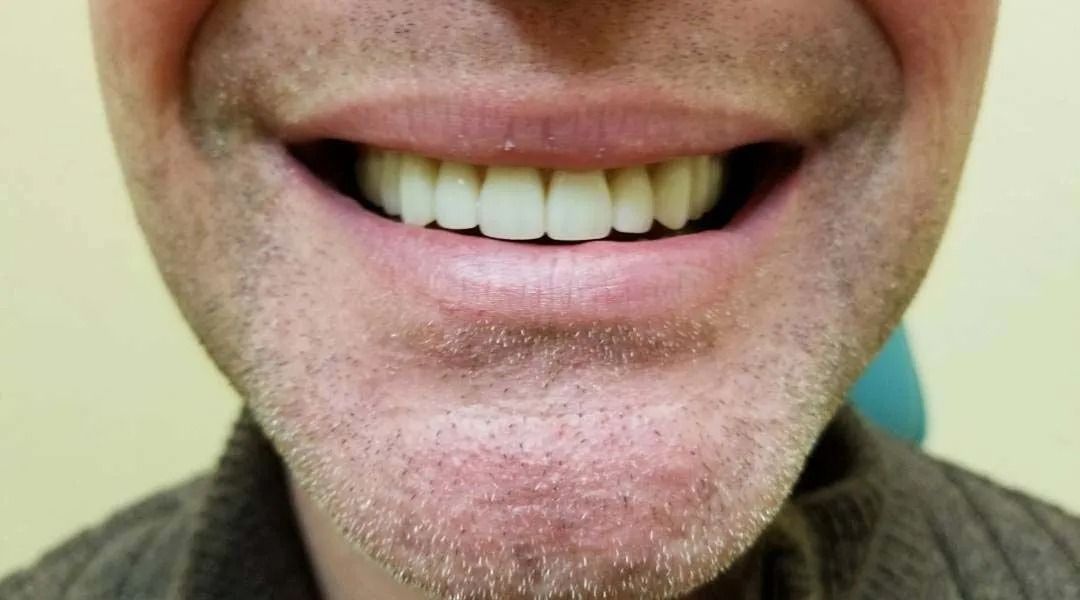 Close-up of a person's smiling mouth showing a row of white teeth; light skin and stubble.