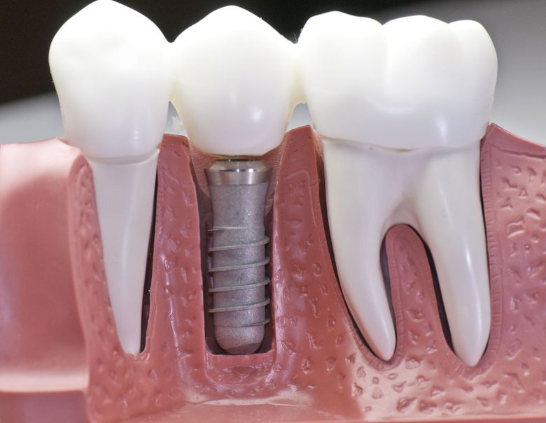 Dental model displaying a tooth implant with surrounding teeth and gum structure.