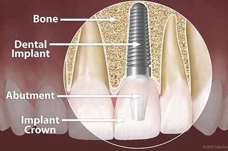 Dental implants