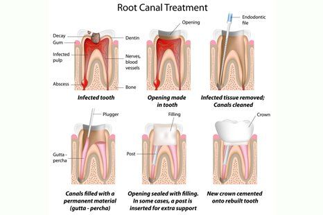 Root canal treatment