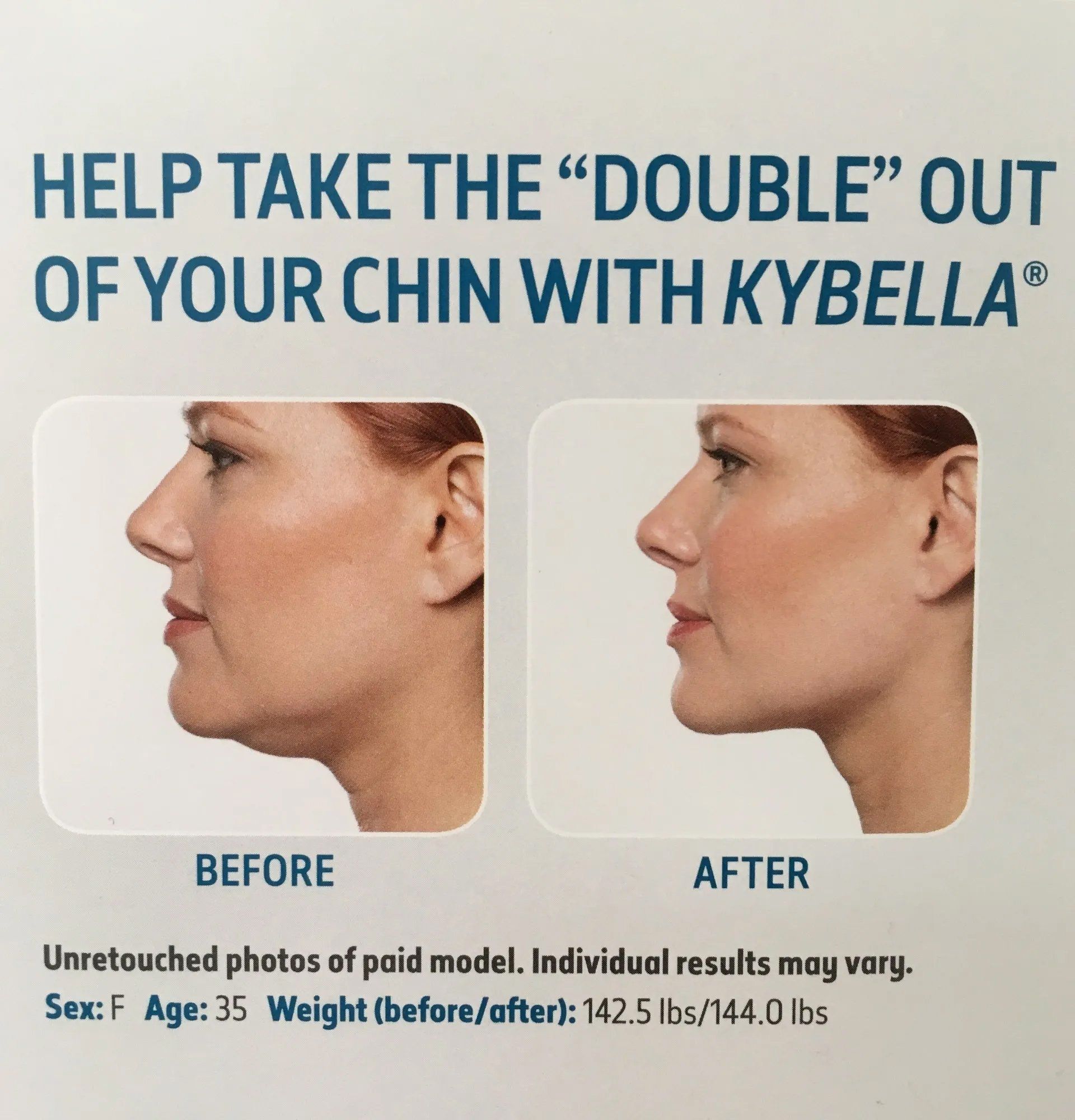 Wrinkle Reduction Springfield, IL Babich Skin Care