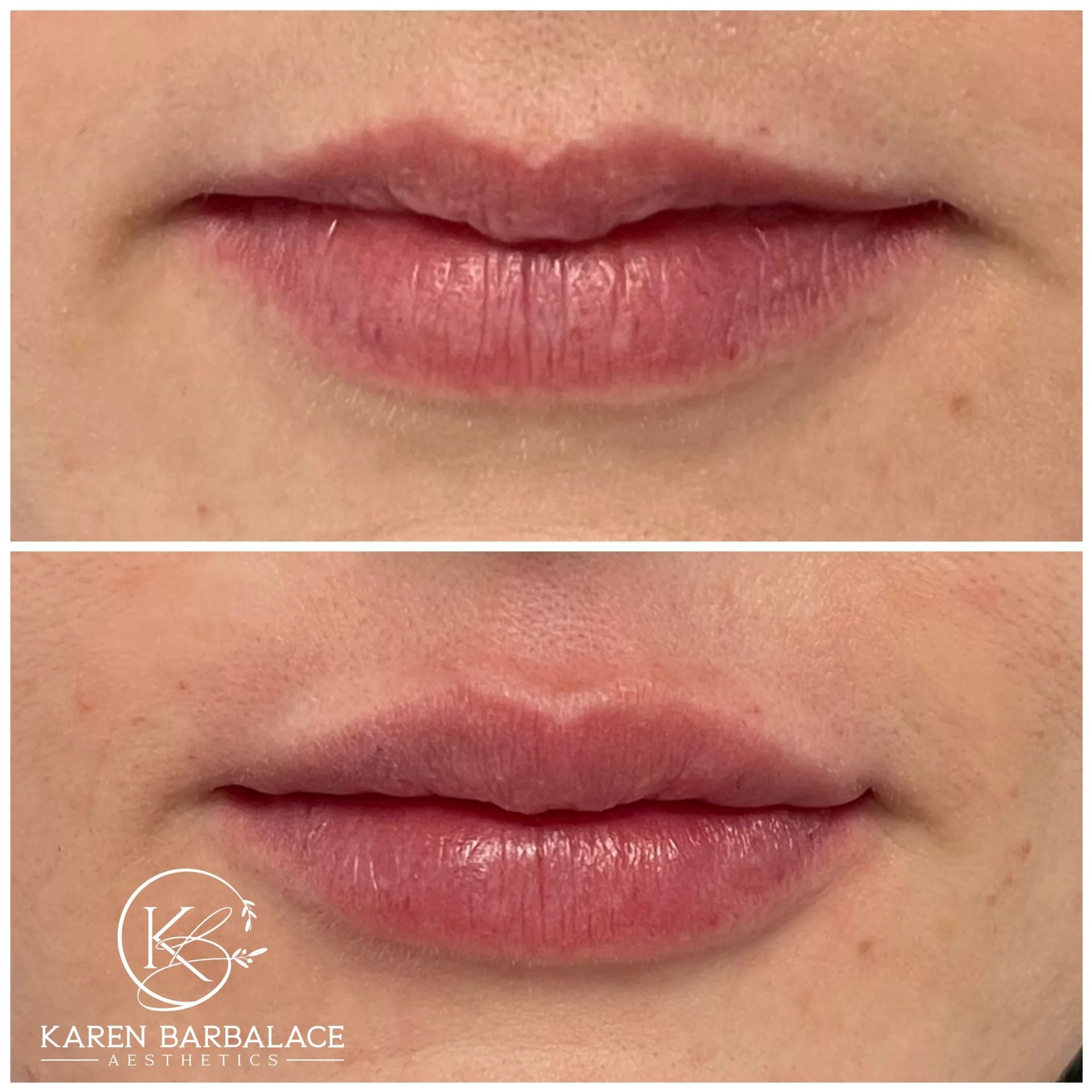Top: natural lips. Bottom: lips after lip filler. Both are pink and close-up.
