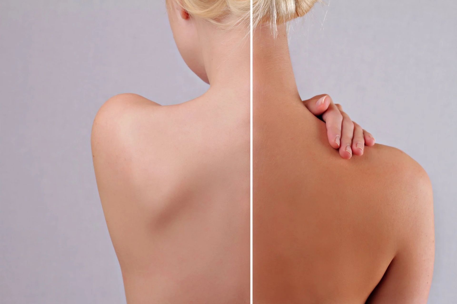 Back of a person's upper body showing a comparison of untanned skin on the left and tanned skin on the right.