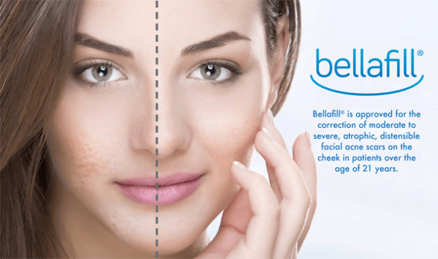 A woman's face with acne scars on one side, a dotted line dividing the face, and Bellafill logo.