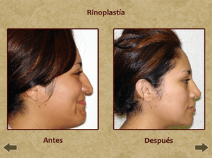 Before and after nose surgery