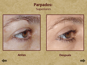 Before and after eye enhancement