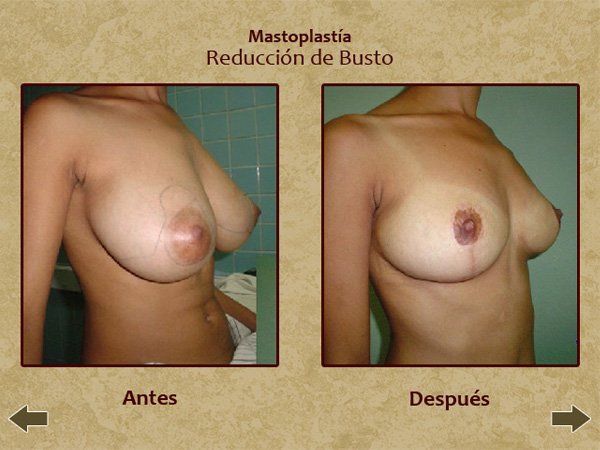 Before and after breast reduction