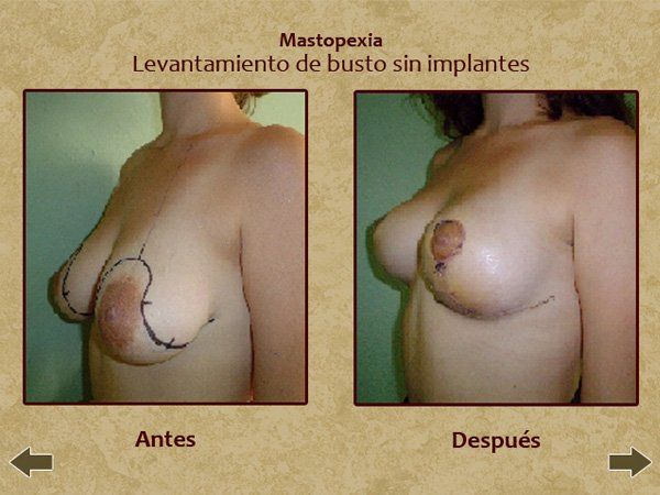 Before and after breast augmentation