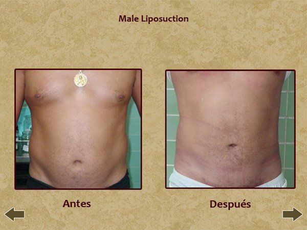 Before and after male liposuction