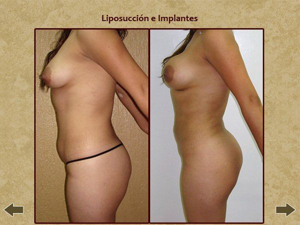 Before and after buttocks enhancement