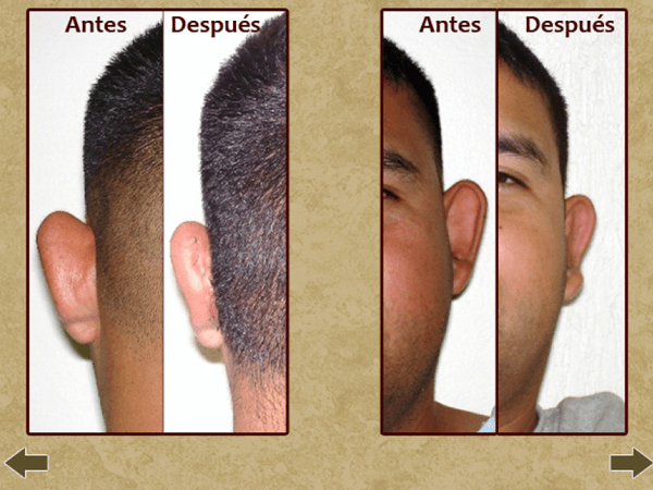 Before and after hair surgery