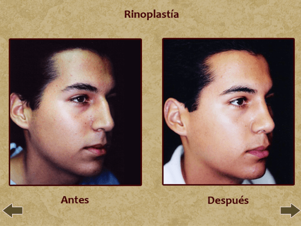 Before and after face surgery