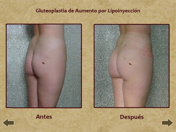 Before and after buttocks enhancement