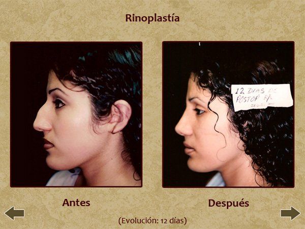 Before and after nose surgery