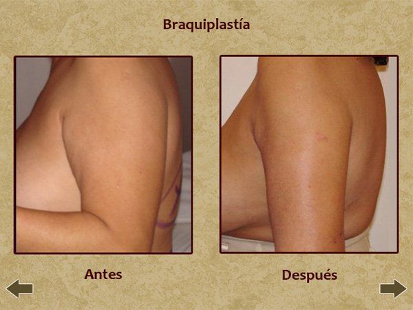 Before and after arm tuck