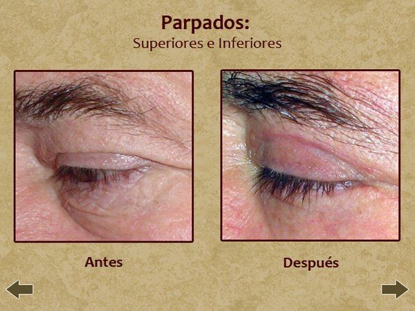 Before and after eye enhancement