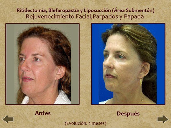 Evo3 before and after