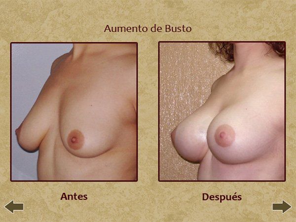 Before and after breast augmentation