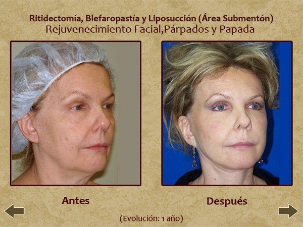 Before and after face lift