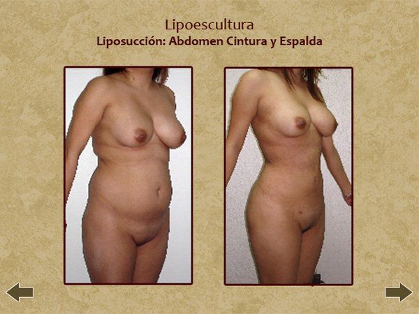 Before and after liposculture