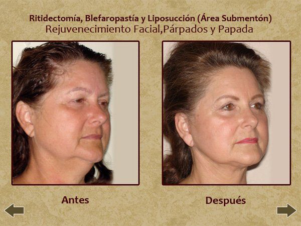 Before and after face lift