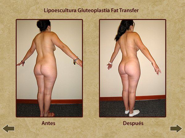 Before and after Lipoescultura Gluteoplastia Fat Transfer