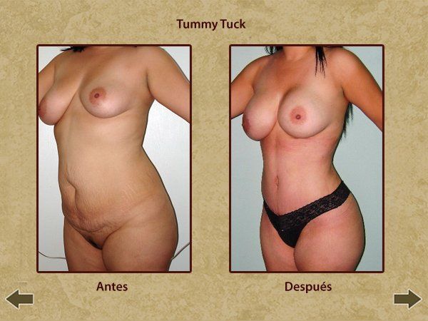 Before and after tummy tuck