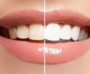 Teeth-color restorations
