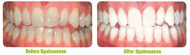 Professional Results with Opalescence™ teeth whitening 