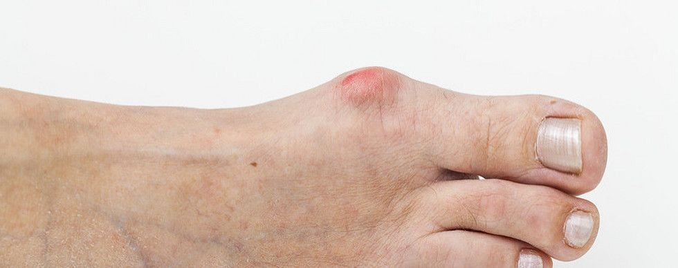 Gout treatment
