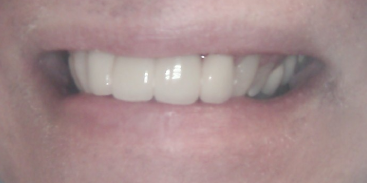 Close-up of a person's smiling mouth. The teeth are white and the lips are pink.