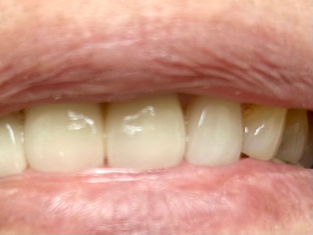 Close-up of a person's teeth. White teeth are visible, with the lips partially open.