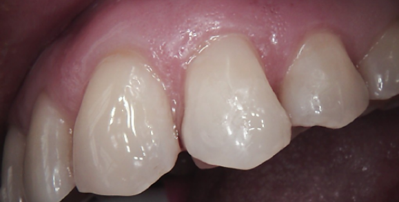 Close-up of upper front teeth, healthy gums, bright white enamel.