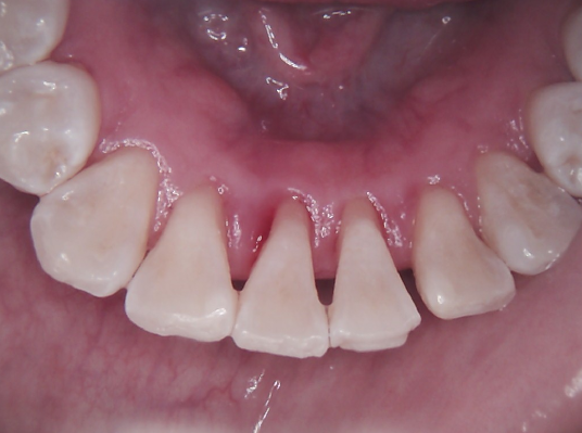 Close-up of human teeth, pink gums, and the inside of the mouth.