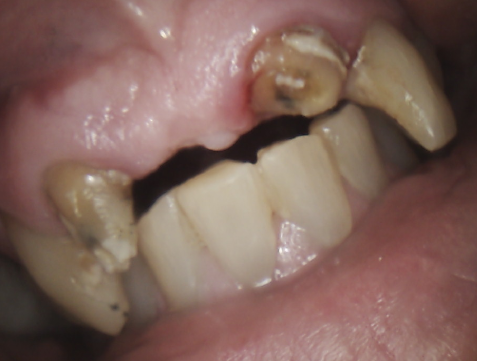 Close-up of a mouth with severely decayed and broken teeth, some with fillings.