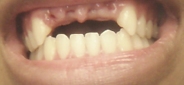 Mouth with visible teeth, including a gap where a tooth is missing.