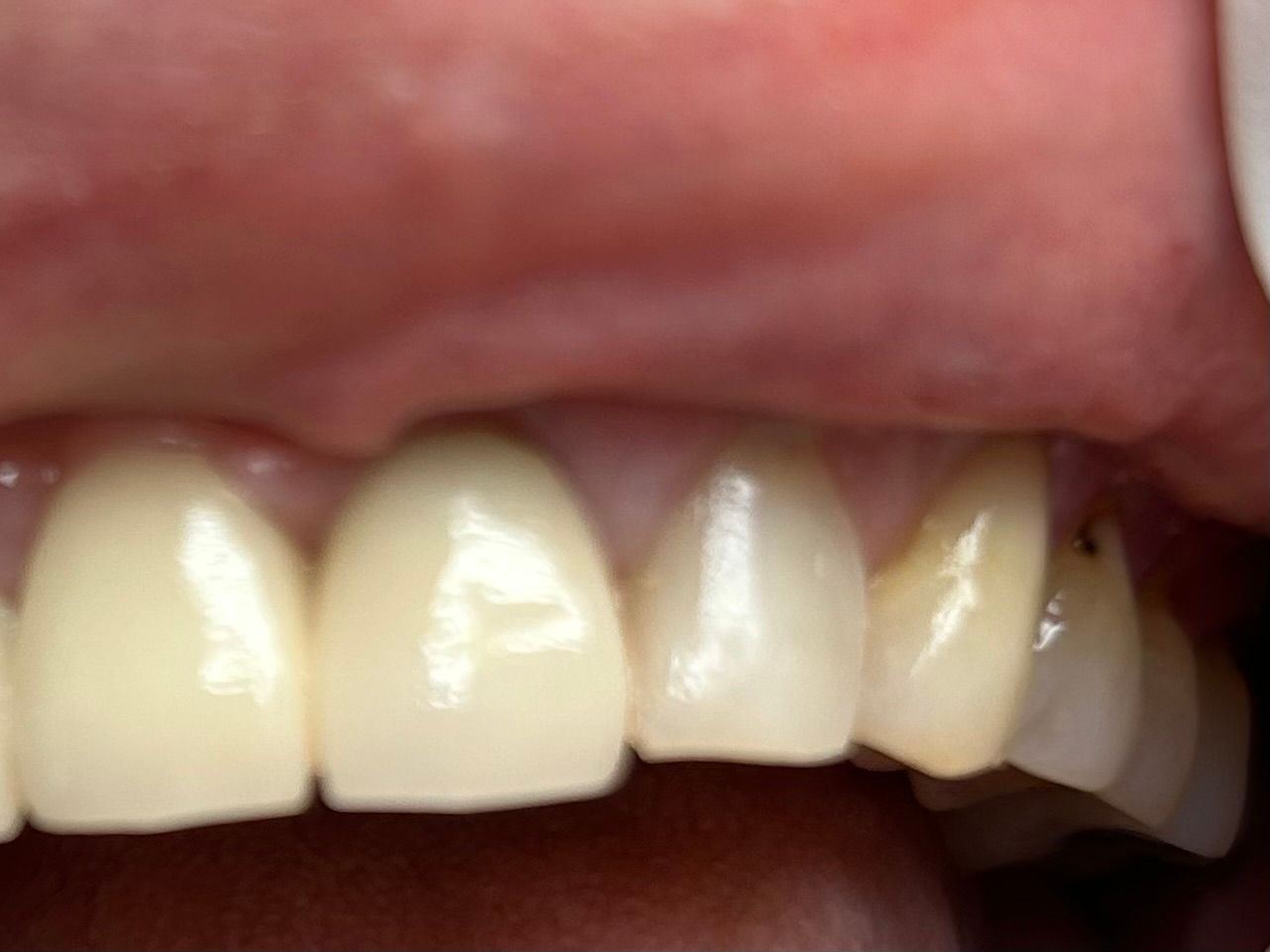 Close-up of teeth. The tooth on the right side has a dark spot.