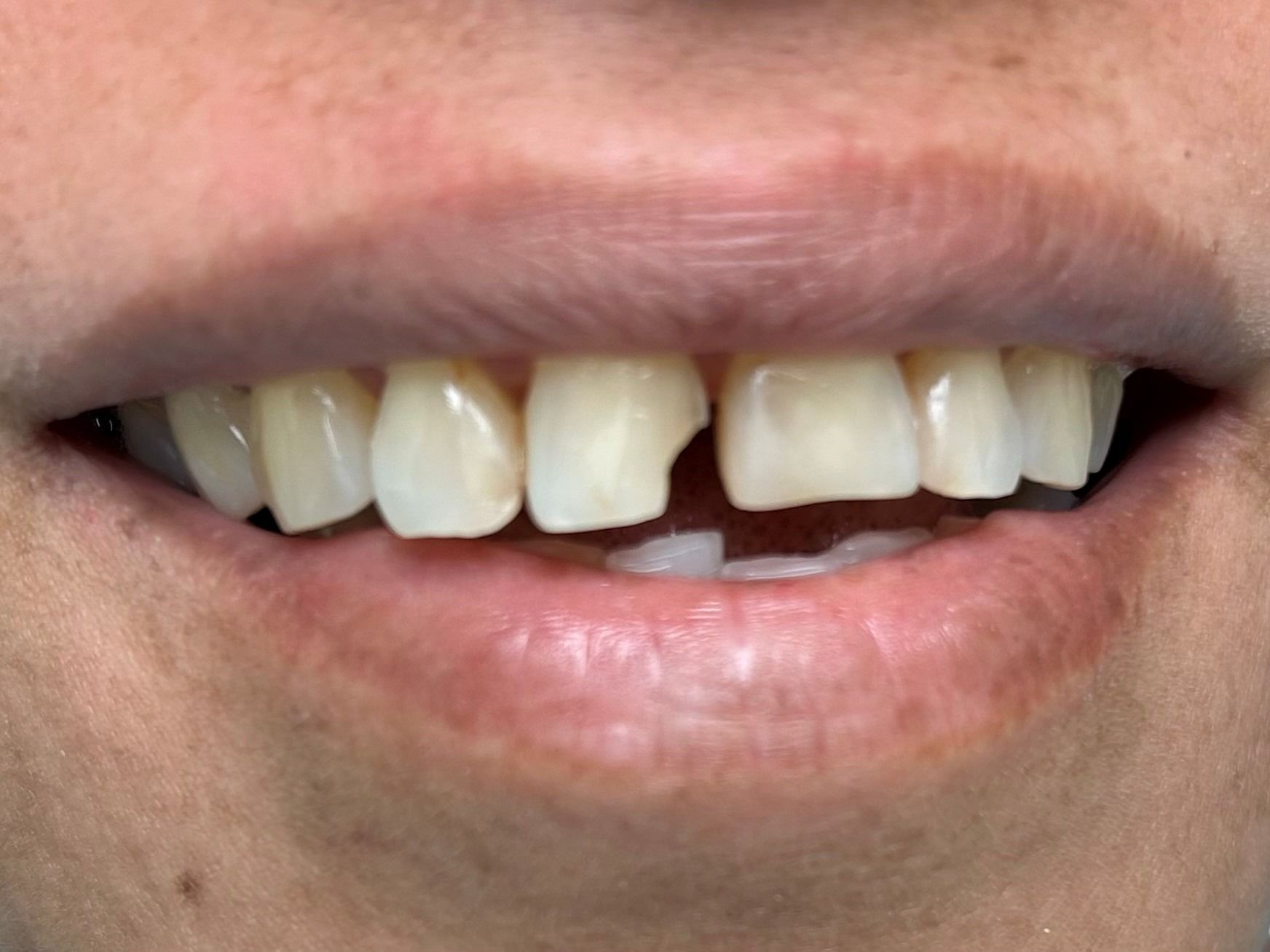 Close-up of a smiling mouth with missing front teeth