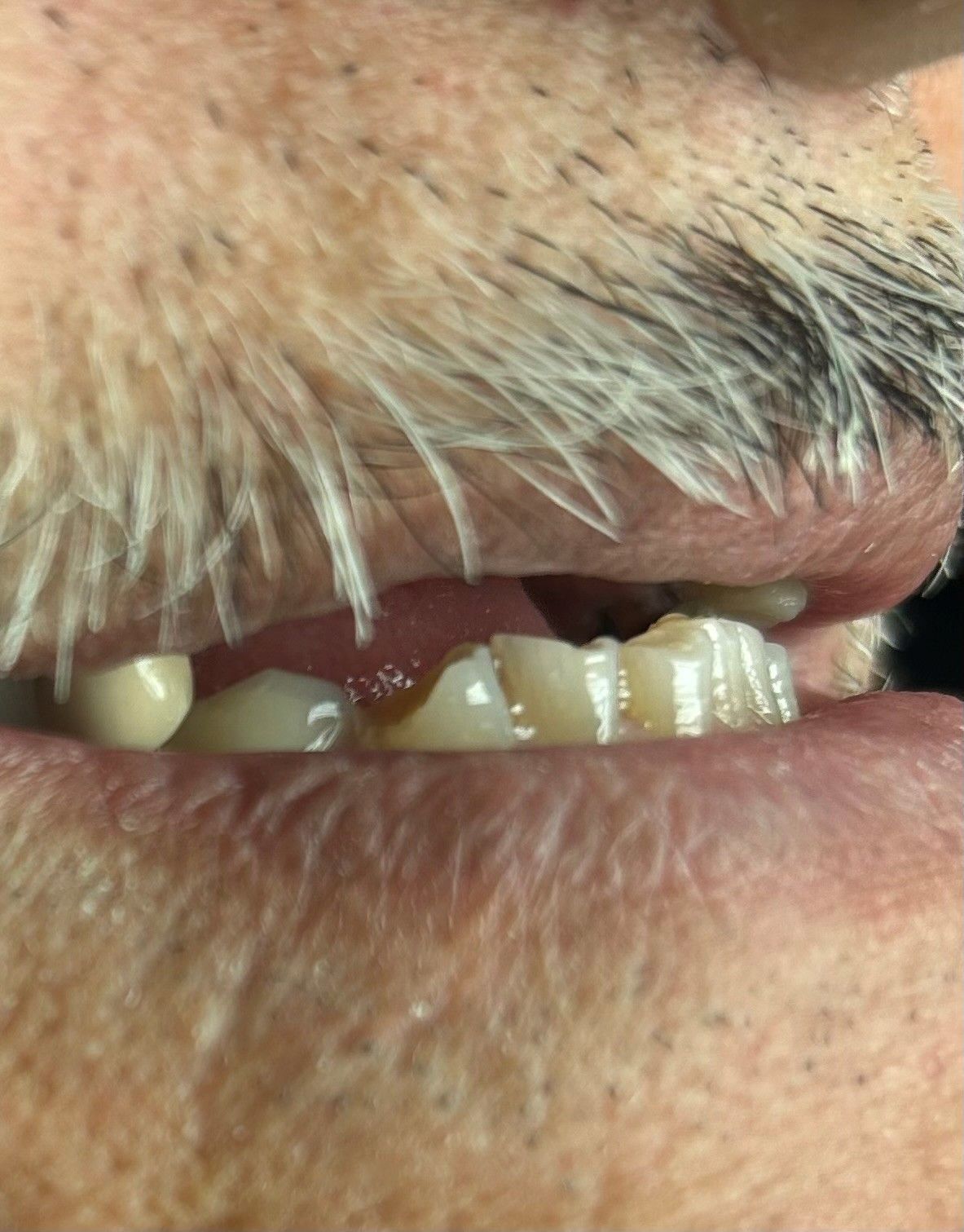 Close-up of an older person's mouth with missing front teeth and a white tooth visible near the lip
